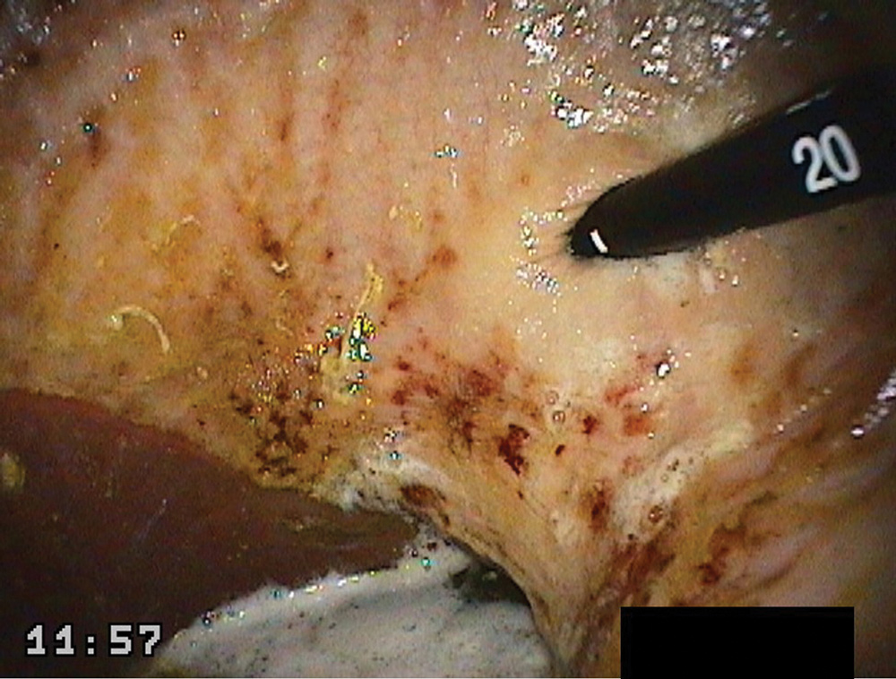 EGUS grade 3 ulcer